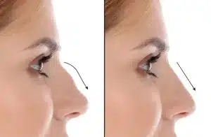 تجارب عملية انحراف الحاجز الأنفي