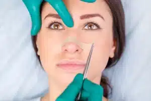 تجميل الانف بالليزر